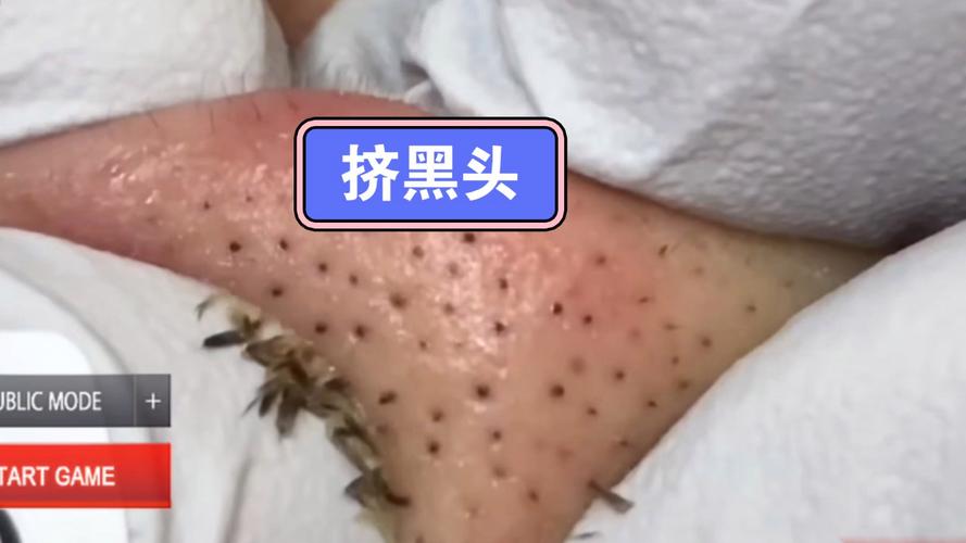 我爱挤黑头发布版