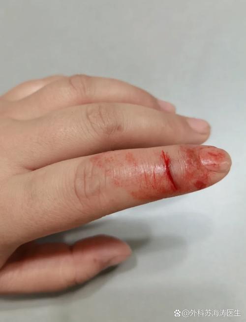 刀戳手指缝